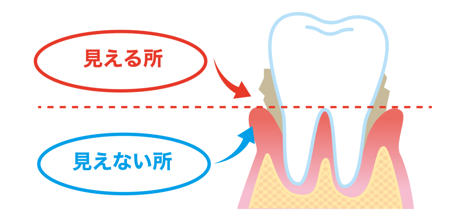 『歯垢（プラーク）』について知ろう