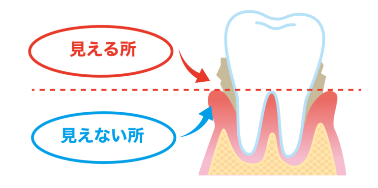 『歯垢（プラーク）』について知ろう