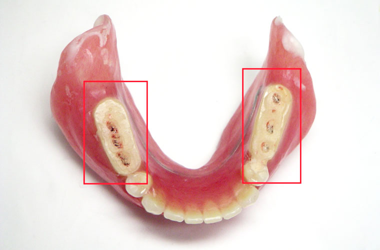 口の動きを理解する「診断用義歯」