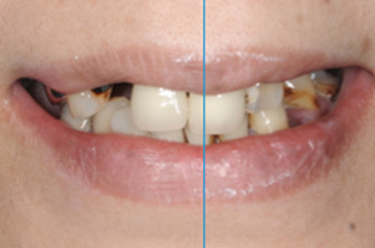 顔の真ん中と前歯の中心の一致