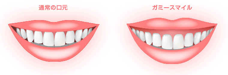 笑うと歯茎が見える「ガミースマイル」の治療も可能です