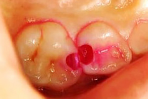 虫歯を赤く染める「う蝕検知液」